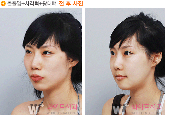 양악수술, 턱이 예뻐진다? | bnt뉴스
