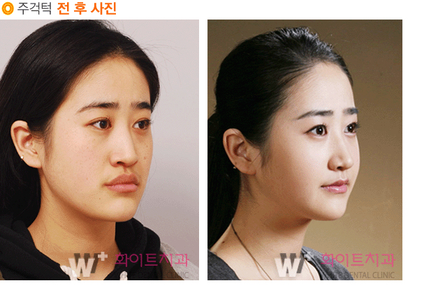 건강한 삶의 지수를 높이기 위한 턱교정, 양악수술 | bnt뉴스