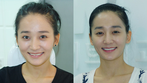 치아교정이 부담스럽다면, 라미네이트는 어때? | bnt뉴스 치아교정이 부담스럽다면, 라미네이트는 어때? | Bnt뉴스