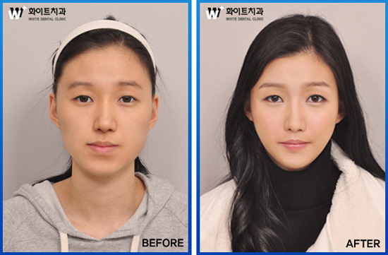 얼굴 틀어진 안면비대칭, 양악수술로 균형 맞춘다 | bnt뉴스 얼굴 틀어진 안면비대칭, 양악수술로 균형 맞춘다 | Bnt뉴스