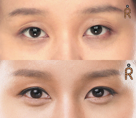 흐리멍덩한 인상의 '번데기쌍꺼풀' 해결 방법은? | bnt뉴스 흐리멍덩한 인상의 '번데기쌍꺼풀' 해결 방법은? | Bnt뉴스