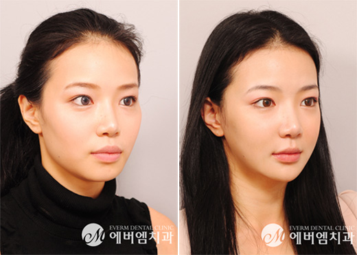 양악수술을 부르는 '얼굴' | bnt뉴스 양악수술을 부르는 '얼굴' | Bnt뉴스