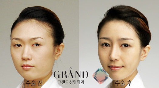 '코성형+무턱수술' 함께하면 효과 2배! | bnt뉴스