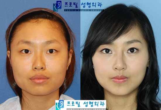 강한 사각턱은 팔자가 세다? 양악수술이면 걱정 없다 | bnt뉴스