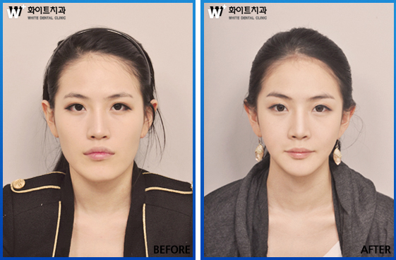 양악수술, 연예인 얼굴 안부럽다? | bnt뉴스 양악수술, 연예인 얼굴 안부럽다? | Bnt뉴스