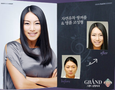 쌍꺼풀수술과 코성형, 실패나 재수술로 이어지지 않으려면? | bnt뉴스 쌍꺼풀수술과 코성형, 실패나 재수술로 이어지지 않으려면? | Bnt뉴스