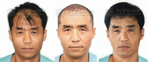 심한 탈모, 외모가 중요한 직업이면 '비절개 모발이식'이 적합 | bnt뉴스 심한 탈모, 외모가 중요한 직업이면 '비절개 모발이식'이 적합 | Bnt뉴스