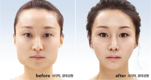 ‘V라인사각턱수술’로 세련되고 갸름한 V라인 얼굴 완성 | bnt뉴스