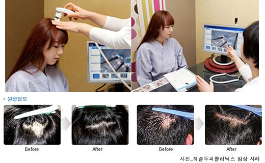 학생, 직장인 원형 탈모? 2030 위험 신호 | bnt뉴스 학생, 직장인 원형 탈모? 2030 위험 신호 | Bnt뉴스